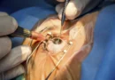 Mutirão disponibiliza 1,4 mil vagas para avaliação e cirurgia de catarata em Teresina