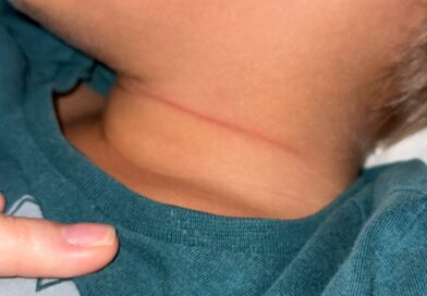 Criança de 4 anos escapa de tragédia após linha com cerol cortar seu pescoço em Parnaíba